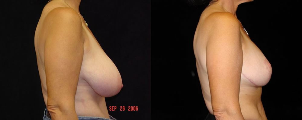 Breast Reduction Before & After Patient #1089