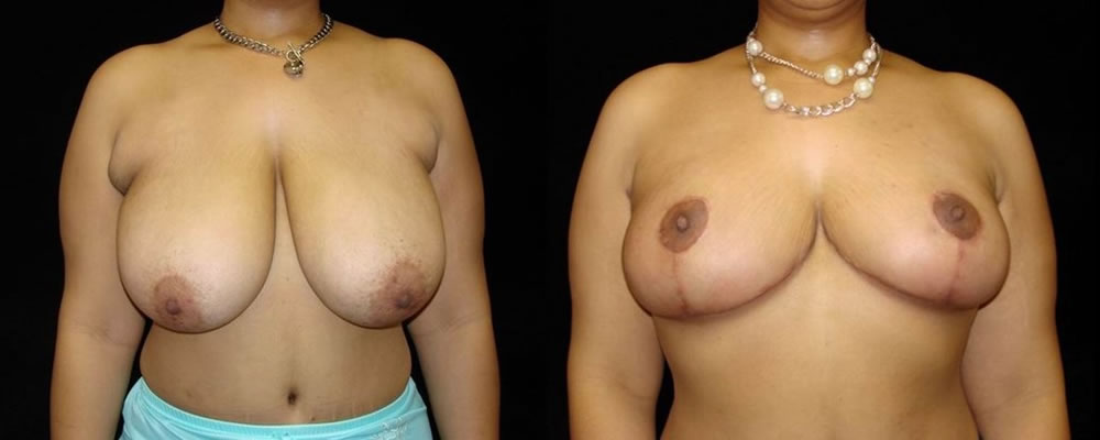 Breast Reduction Before & After Patient #1085