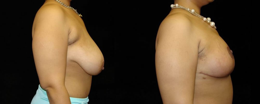 Breast Reduction Before & After Patient #1085