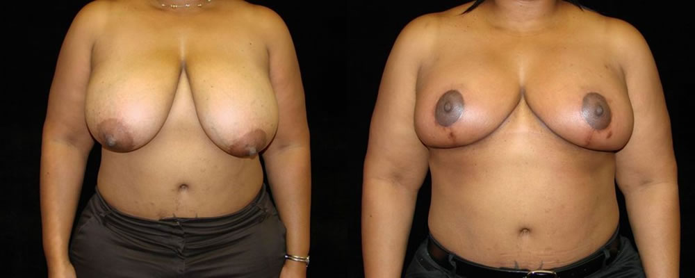 Breast Reduction Before & After Patient #1081
