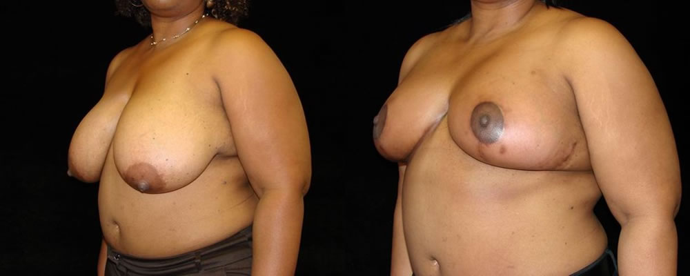 Breast Reduction Before & After Patient #1081