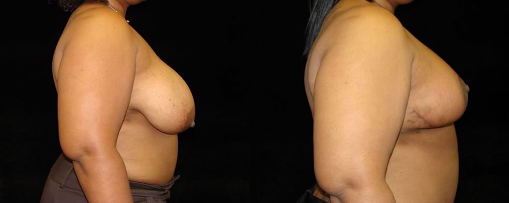 Breast Reduction Before & After Patient #1081