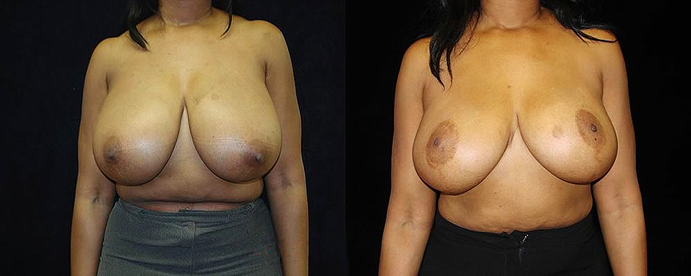 Breast Reduction Before & After Patient #1077