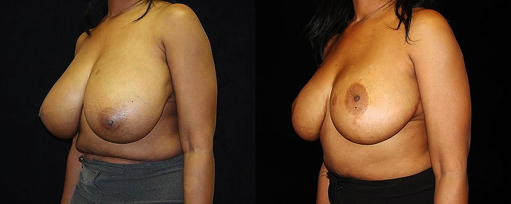 Breast Reduction Before & After Patient #1077