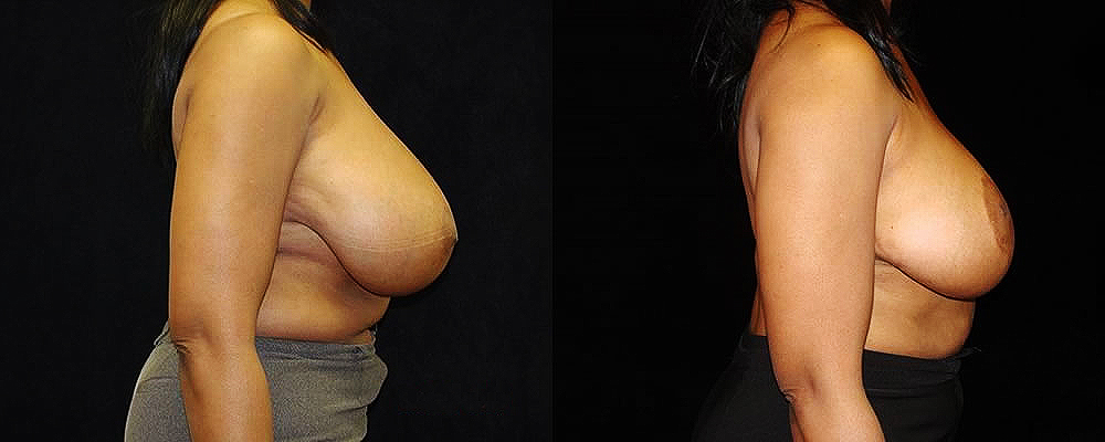 Breast Reduction Before & After Patient #1077