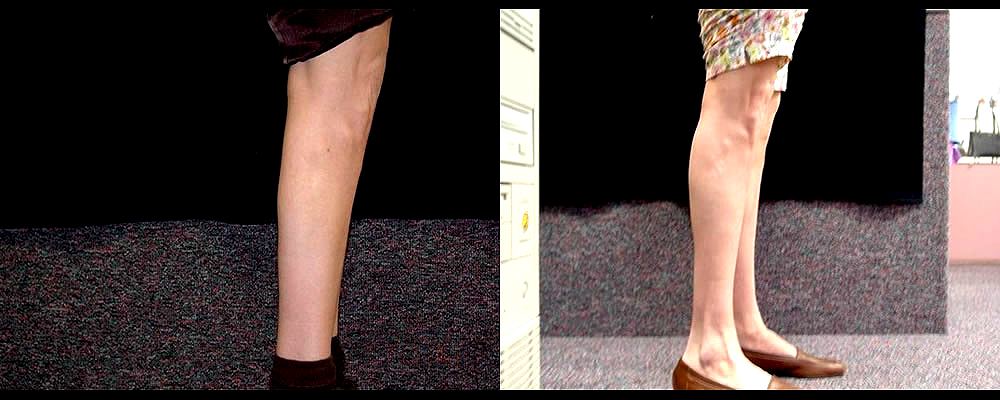 Calf Implants Before & After Patient #276
