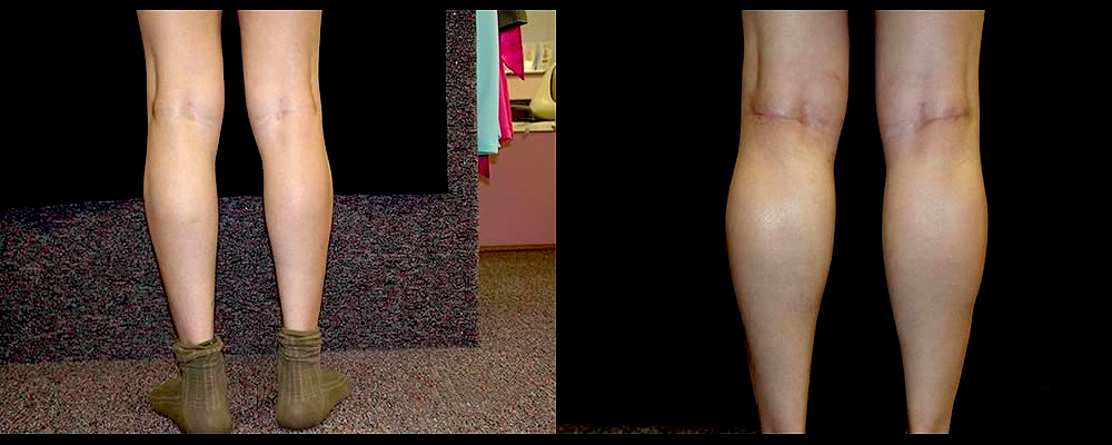 Calf Implants Before & After Patient #269