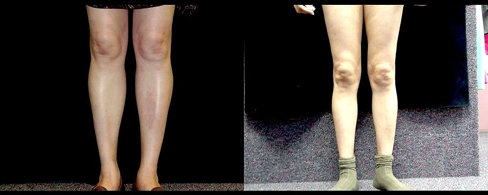 Calf Implants Before & After Patient #269