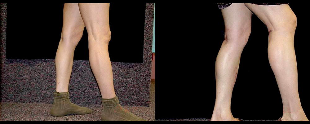 Calf Implants Before & After Patient #269