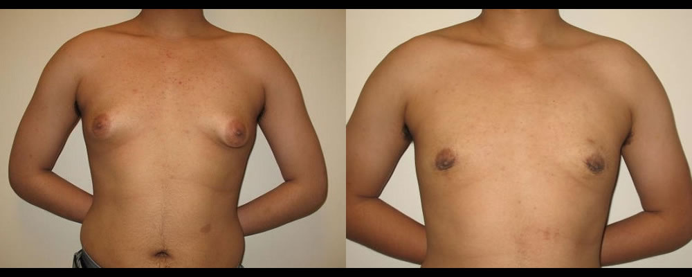 Gynecomastia Before & After Patient #1113