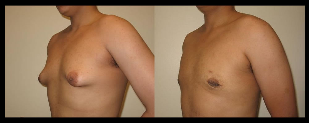 Gynecomastia Before & After Patient #1113