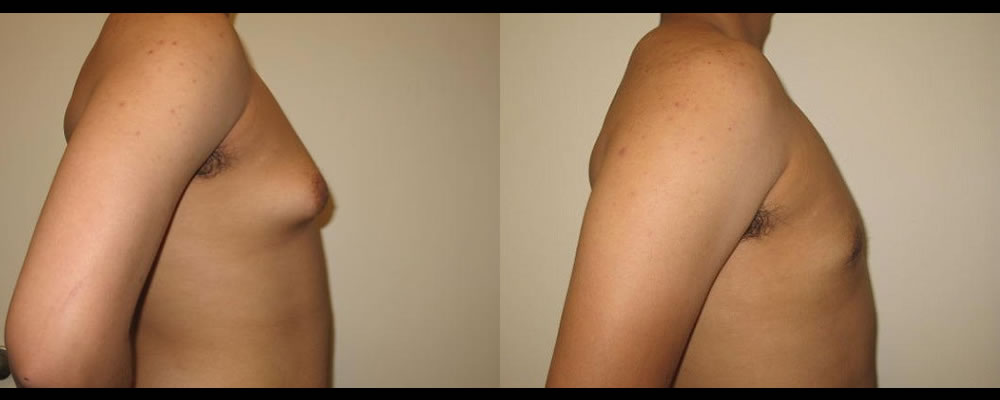 Gynecomastia Before & After Patient #1113