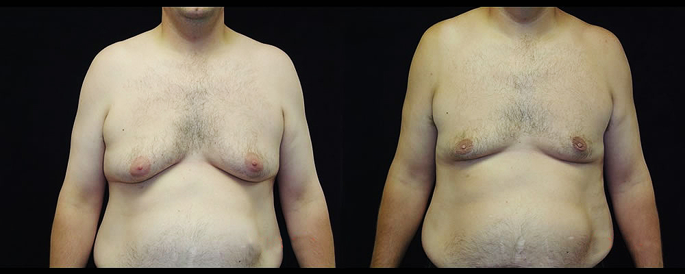 Gynecomastia Before & After Patient #1109