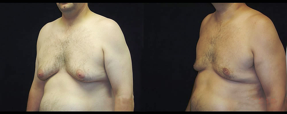 Gynecomastia Before & After Patient #1109