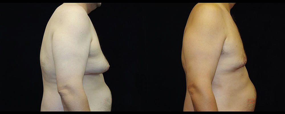 Gynecomastia Before & After Patient #1109