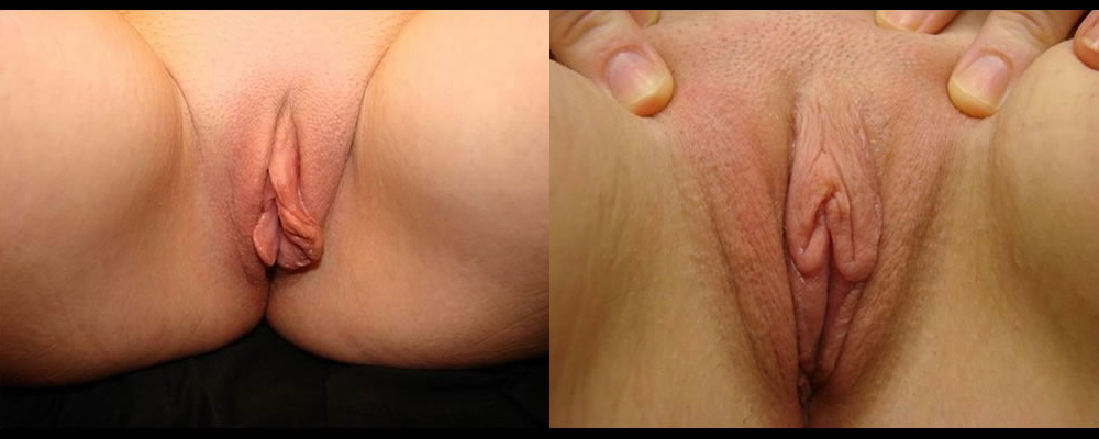 Labiaplasty Before & After Patient #288