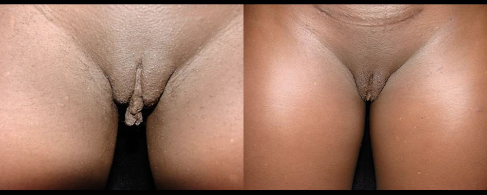 Labiaplasty Before & After Patient #286