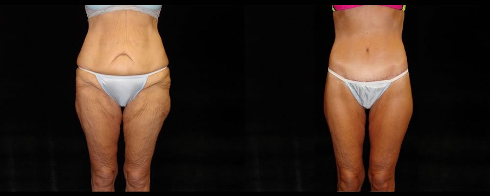 Lower Body Lift Before & After Patient #429