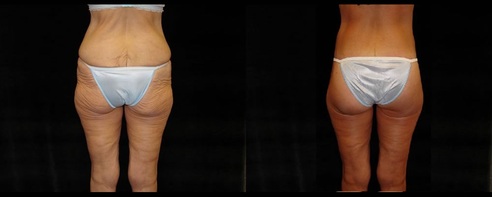 Lower Body Lift Before & After Patient #429