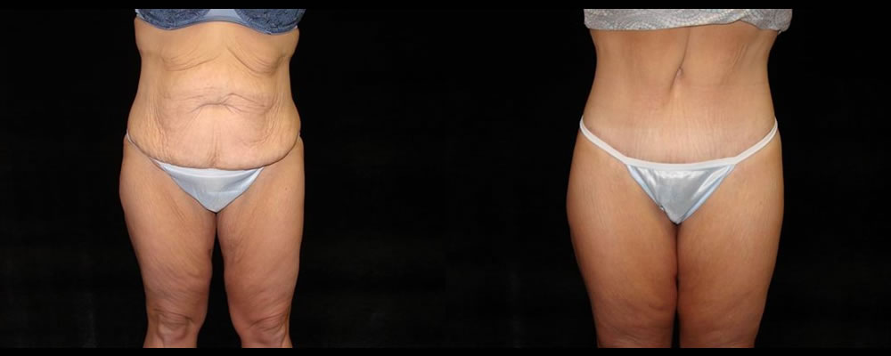Lower Body Lift Before & After Patient #425