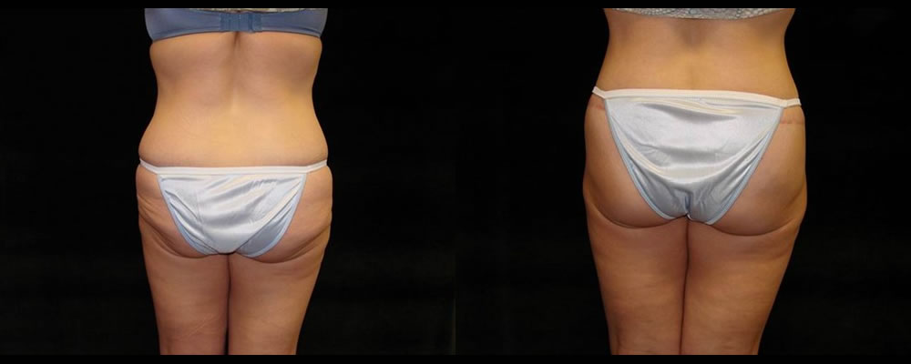 Lower Body Lift Before & After Patient #425