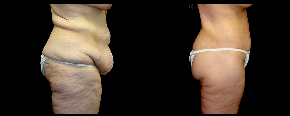 Lower Body Lift Before & After Patient #421