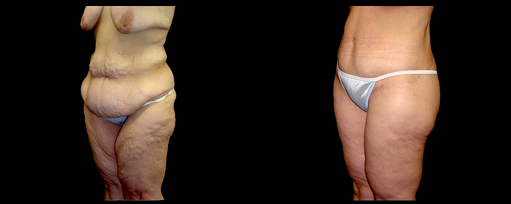 Lower Body Lift Before & After Patient #421