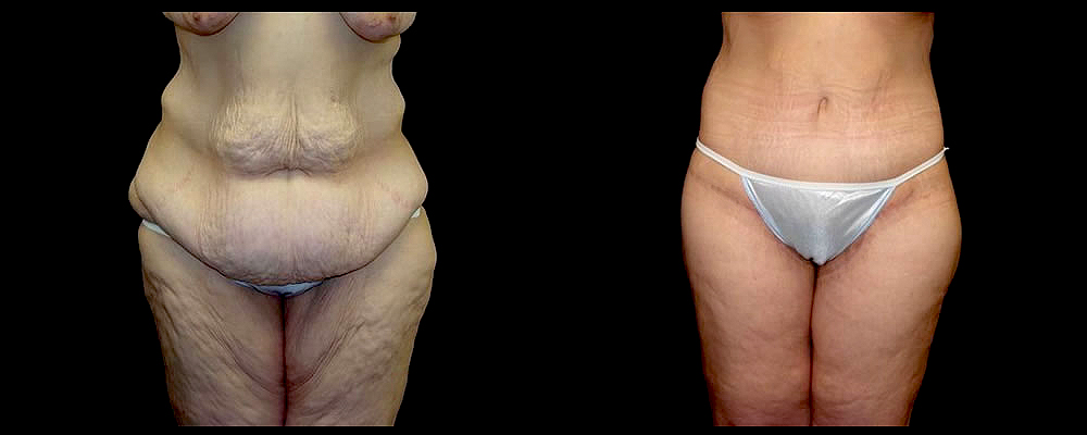 Lower Body Lift Before & After Patient #421