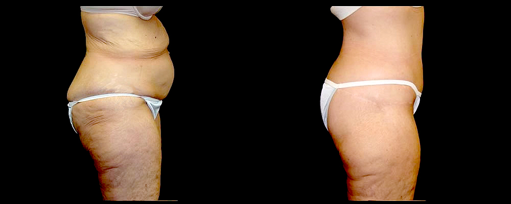 Lower Body Lift Before & After Patient #417