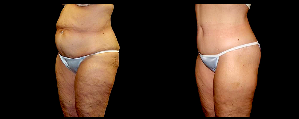 Lower Body Lift Before & After Patient #417