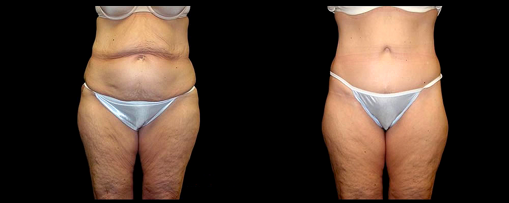 Lower Body Lift Before & After Patient #417