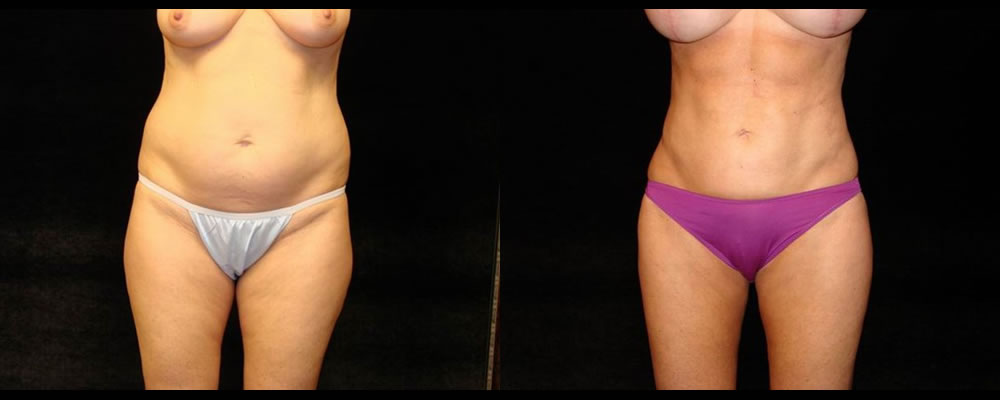 Liposuction Before & After Patient #406