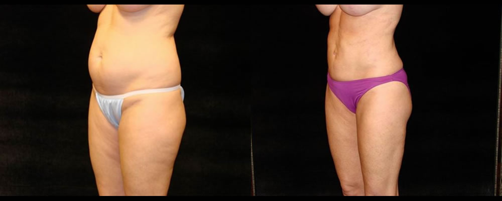Liposuction Before & After Patient #406