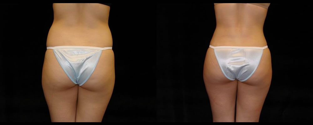 Liposuction Before & After Patient #371