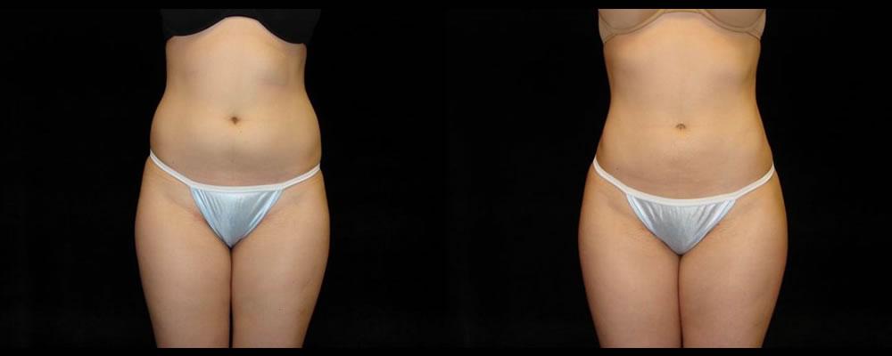 Liposuction Before & After Patient #371