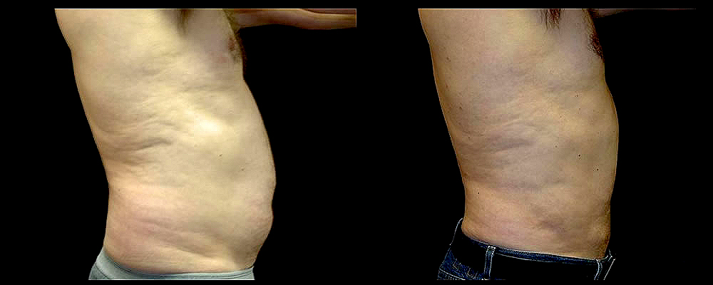 Liposuction Before & After Patient #367