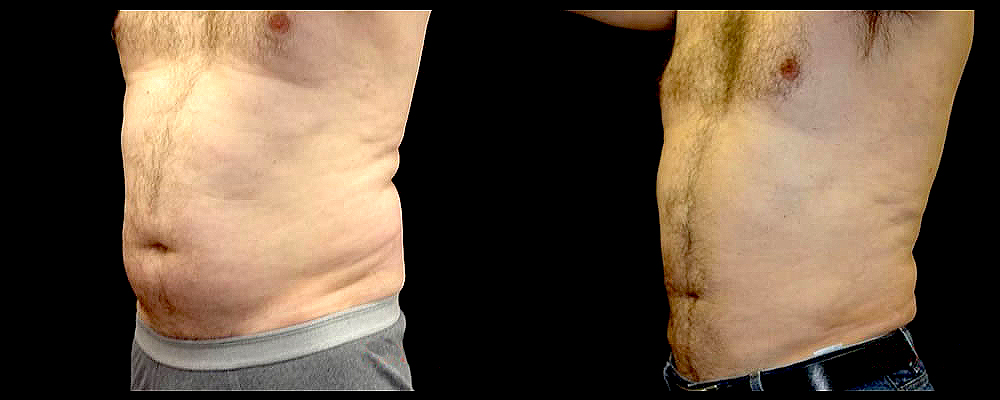 Liposuction Before & After Patient #367