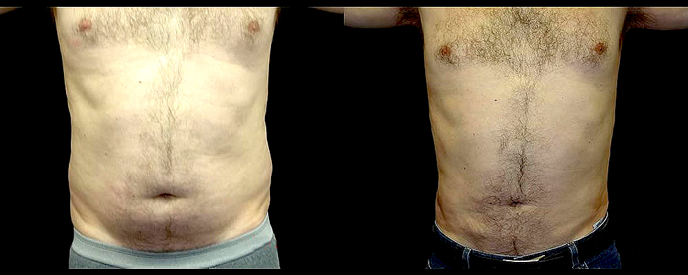 Liposuction Before & After Patient #367