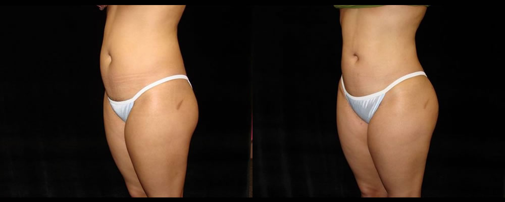 Liposuction Before & After Patient #363
