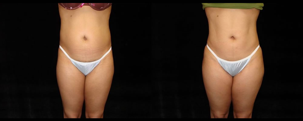 Liposuction Before & After Patient #363