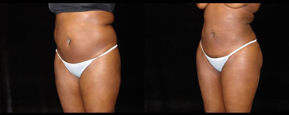 Liposuction Before & After Patient #359
