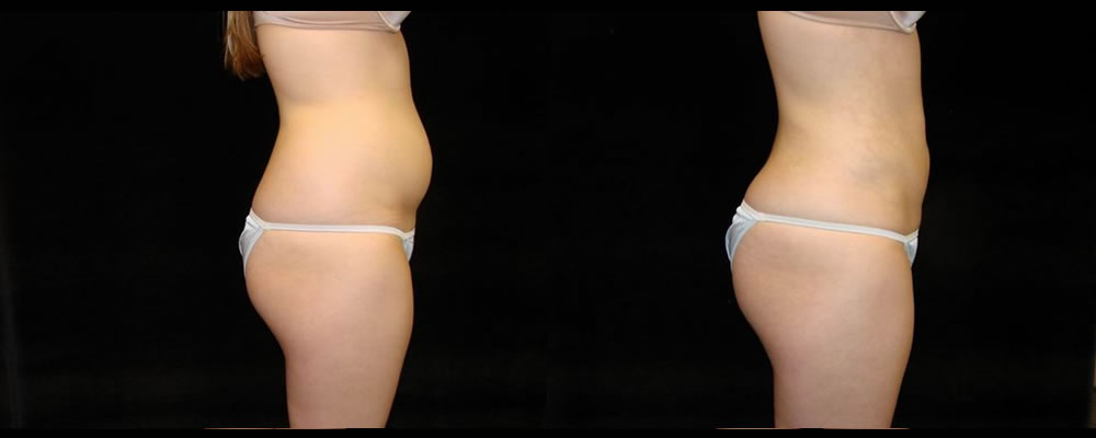 Liposuction Before & After Patient #355
