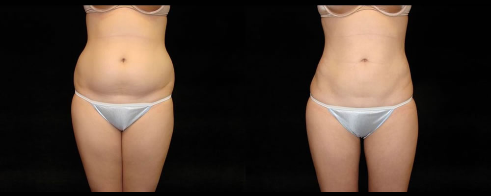 Liposuction Before & After Patient #355