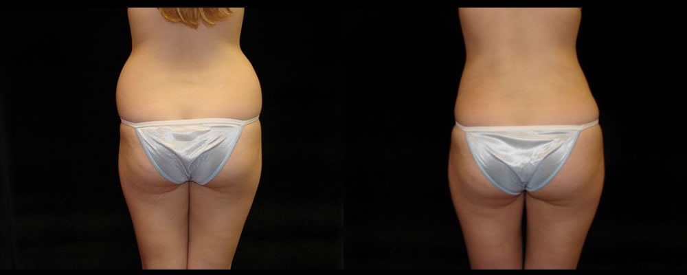 Liposuction Before & After Patient #355