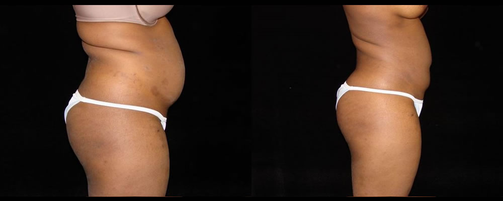 Liposuction Before & After Patient #351