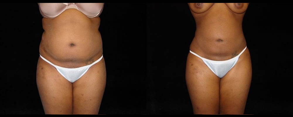 Liposuction Before & After Patient #351