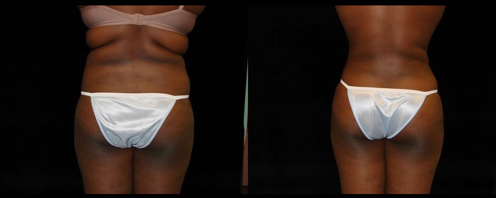Liposuction Before & After Patient #351