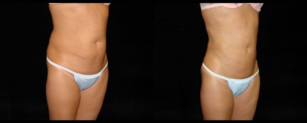 Liposuction Before & After Patient #347