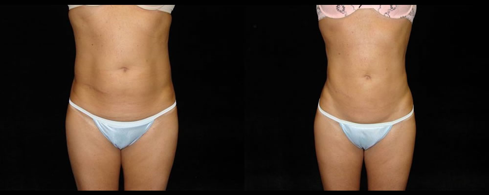 Liposuction Before & After Patient #347