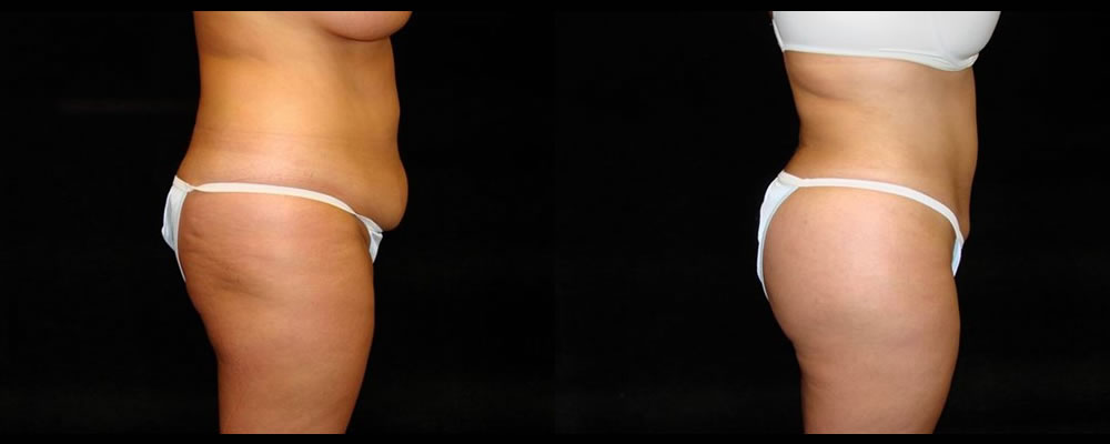 Liposuction Before & After Patient #343